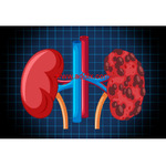 Diabetes and Kidney Disease: Understanding the Connection and Prevention